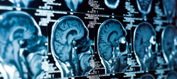 Искусственный интеллект научили выявлять сужение мозговых артерий